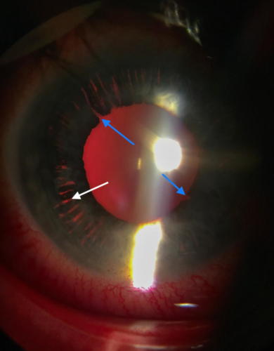 Contusion of the eyeball - the iris damage